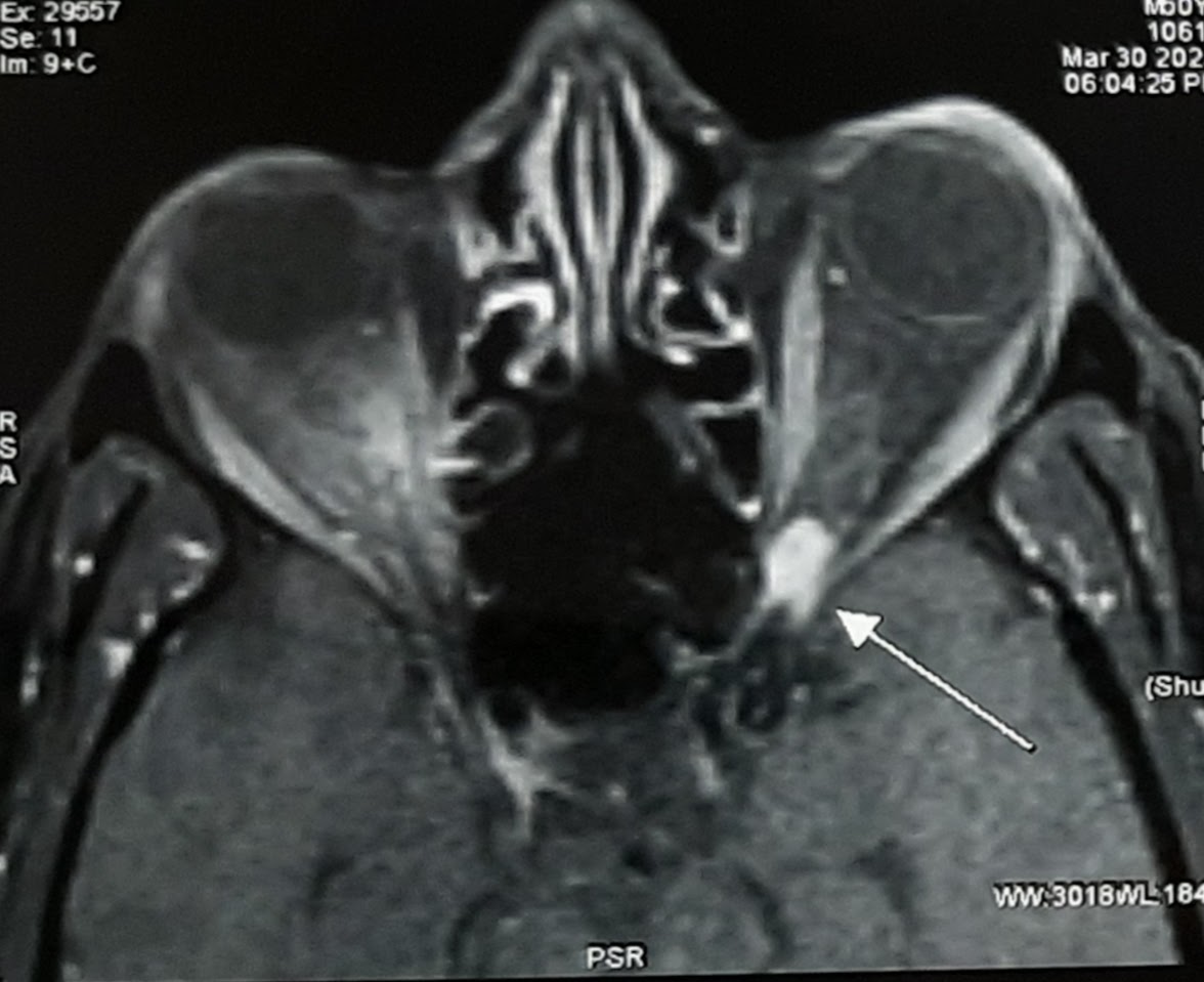 CT scan showing blow out fracture